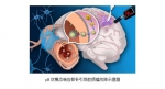 文汇：复旦发现新型纳米探针用于脑胶质瘤手术导航 - 复旦大学
