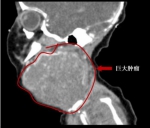 新生儿颈部挂另一个“脑袋”呼吸困难，实为巨大肿瘤来沪切除 - 上海女性
