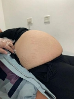 15岁少女长满“妊娠纹”咋回事？国妇婴只用小肚脐就解决了腹中巨大包块 - 上海女性